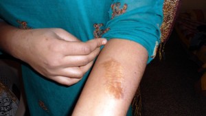 Women in Pakistan. Healing scars, symbol of violence © DW